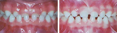 before and after showing how braces can help the development of a child's teeth