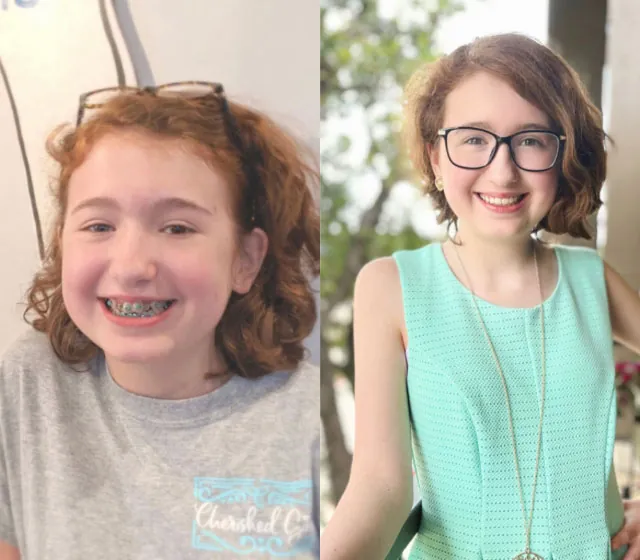 before and after look at a patient's smile after getting braces at Boerne, TX dental office The Kid's Place