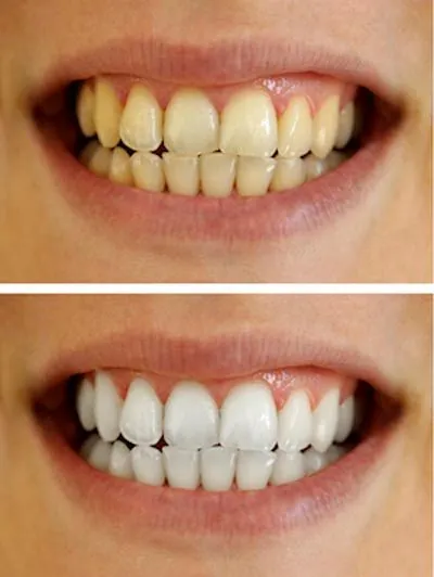 before and after teeth whitening at The Kid's Place in Boerne, TX