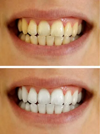 Opalescence: Whitening Smiles for 30 Years